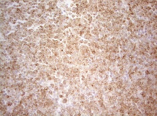 ALOX5 / 5-LOX Antibody - Immunohistochemical staining of paraffin-embedded Human lymphoma tissue using anti-ALOX5 mouse monoclonal antibody. (Heat-induced epitope retrieval by 1mM EDTA in 10mM Tris buffer. (pH8.5) at 120°C for 3 min. (1:150)