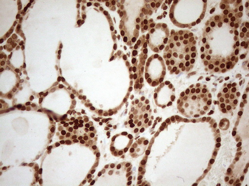ALOX5 / 5-LOX Antibody - Immunohistochemical staining of paraffin-embedded Human thyroid tissue using anti-ALOX5 mouse monoclonal antibody. (Heat-induced epitope retrieval by 1mM EDTA in 10mM Tris buffer. (pH8.5) at 120°C for 3 min. (1:150)