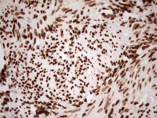 ALOX5 / 5-LOX Antibody - Immunohistochemical staining of paraffin-embedded Human endometrium tissue using anti-ALOX5 mouse monoclonal antibody. (Heat-induced epitope retrieval by 1mM EDTA in 10mM Tris buffer. (pH8.5) at 120°C for 3 min. (1:150)