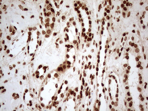 ALOX5 / 5-LOX Antibody - Immunohistochemical staining of paraffin-embedded Human Kidney tissue using anti-ALOX5 mouse monoclonal antibody. (Heat-induced epitope retrieval by 1mM EDTA in 10mM Tris buffer. (pH8.5) at 120°C for 3 min. (1:150)