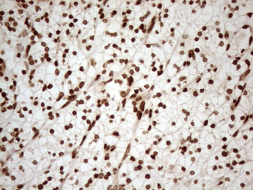 ALOX5 / 5-LOX Antibody - Immunohistochemical staining of paraffin-embedded Carcinoma of Human kidney tissue using anti-ALOX5 mouse monoclonal antibody. (Heat-induced epitope retrieval by 1mM EDTA in 10mM Tris buffer. (pH8.5) at 120°C for 3 min. (1:150)
