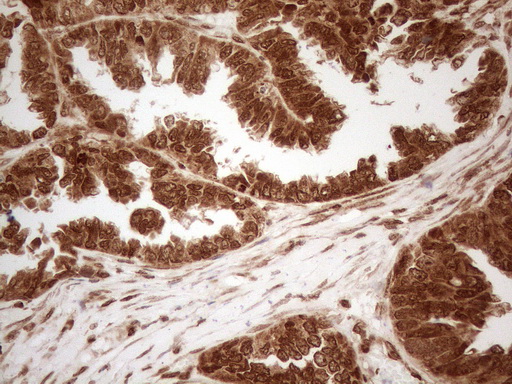 ALOX5 / 5-LOX Antibody - Immunohistochemical staining of paraffin-embedded Adenocarcinoma of Human ovary tissue using anti-ALOX5 mouse monoclonal antibody. (Heat-induced epitope retrieval by 1mM EDTA in 10mM Tris buffer. (pH8.5) at 120°C for 3 min. (1:150)