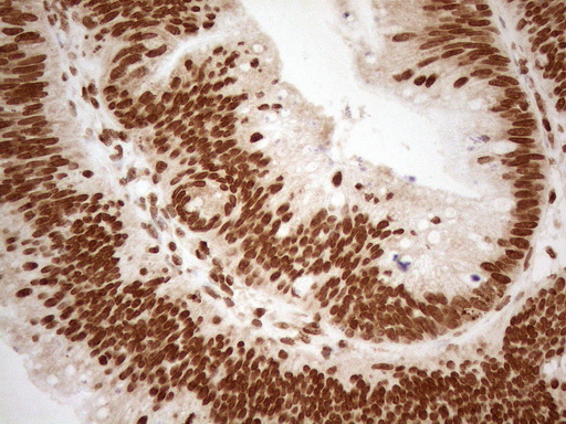ALOX5 / 5-LOX Antibody - Immunohistochemical staining of paraffin-embedded Carcinoma of Human pancreas tissue using anti-ALOX5 mouse monoclonal antibody. (Heat-induced epitope retrieval by 1mM EDTA in 10mM Tris buffer. (pH8.5) at 120°C for 3 min. (1:150)