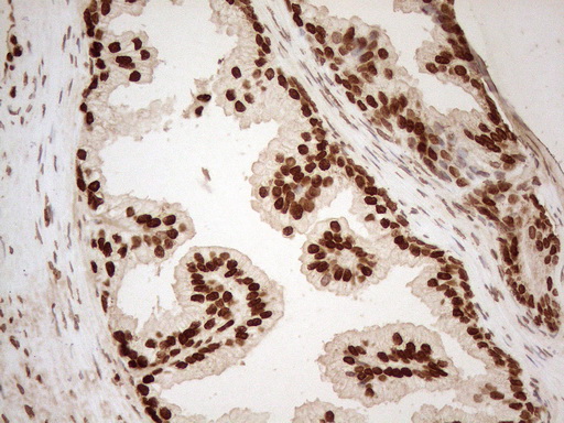 ALOX5 / 5-LOX Antibody - Immunohistochemical staining of paraffin-embedded Human prostate tissue using anti-ALOX5 mouse monoclonal antibody. (Heat-induced epitope retrieval by 1mM EDTA in 10mM Tris buffer. (pH8.5) at 120°C for 3 min. (1:150)