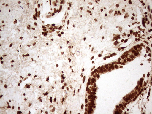 ALOX5 / 5-LOX Antibody - Immunohistochemical staining of paraffin-embedded Carcinoma of Human prostate tissue using anti-ALOX5 mouse monoclonal antibody. (Heat-induced epitope retrieval by 1mM EDTA in 10mM Tris buffer. (pH8.5) at 120°C for 3 min. (1:150)
