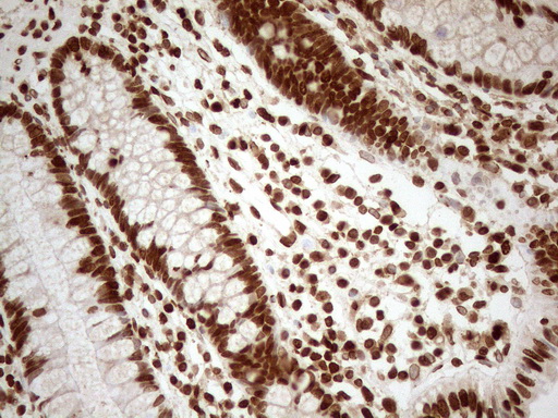 ALOX5 / 5-LOX Antibody - Immunohistochemical staining of paraffin-embedded Human colon tissue using anti-ALOX5 mouse monoclonal antibody. (Heat-induced epitope retrieval by 1mM EDTA in 10mM Tris buffer. (pH8.5) at 120°C for 3 min. (1:150)
