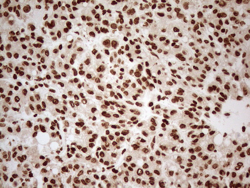 ALOX5 / 5-LOX Antibody - Immunohistochemical staining of paraffin-embedded Human liver tissue using anti-ALOX5 mouse monoclonal antibody. (Heat-induced epitope retrieval by 1mM EDTA in 10mM Tris buffer. (pH8.5) at 120°C for 3 min. (1:150)