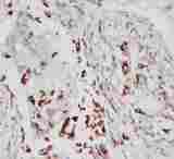 ALOX5 / 5-LOX Antibody - Anti-ALOX5 antibody, IHC(P): Human Lung Cancer Tissue