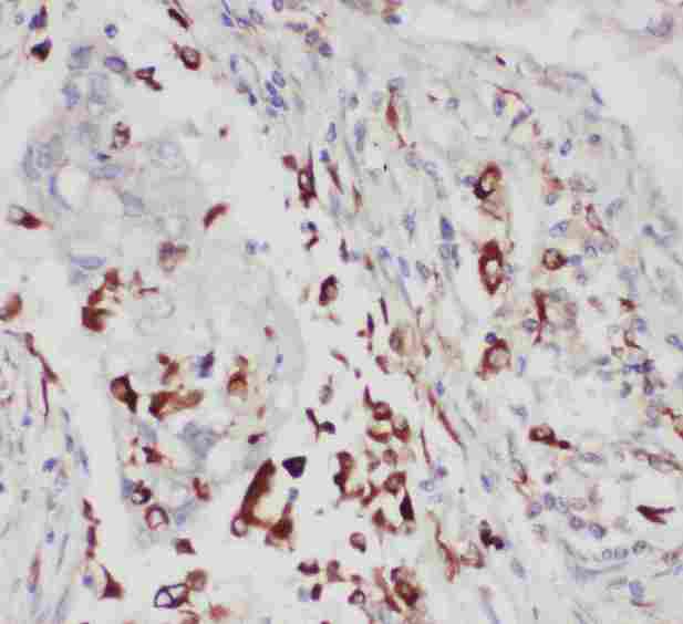 ALOX5 / 5-LOX Antibody - Anti-ALOX5 antibody, IHC(P): Human Lung Cancer Tissue