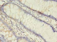 ALOX5 / 5-LOX Antibody - Immunohistochemistry of paraffin-embedded human colon cancer using antibody at dilution of 1:100.