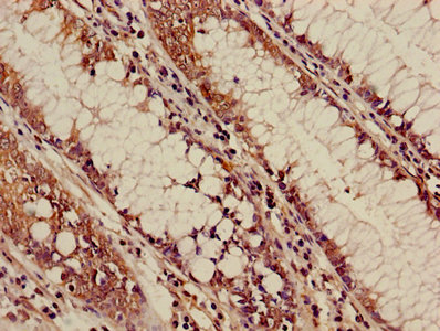 ALOX5 / 5-LOX Antibody - Immunohistochemistry of paraffin-embedded human colon cancer using ALOX5 Antibody at dilution of 1:100