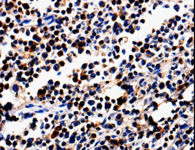 ALOX5 / 5-LOX Antibody - Immunohistochemistry of paraffin-embedded Human colon cancer using ALOX5 Polyclonal Antibody at dilution of 1:50.