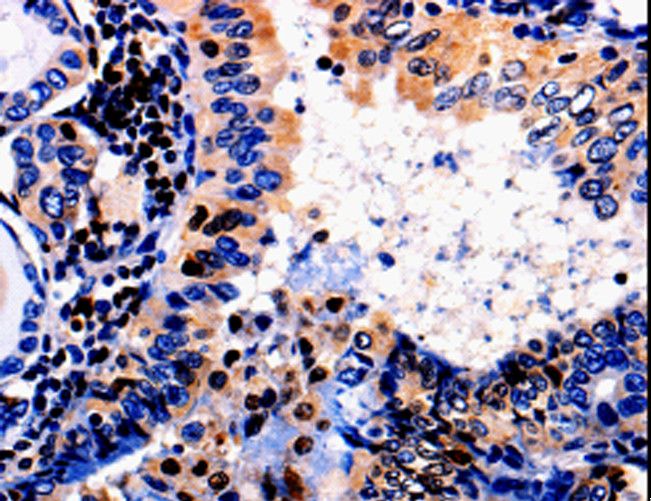 ALOX5 / 5-LOX Antibody - Immunohistochemistry of paraffin-embedded Human colon cancer using ALOX5 Polyclonal Antibody at dilution of 1:50.
