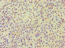 ALOXE3 Antibody - Immunohistochemistry of paraffin-embedded human breast cancer using antibody at 1:100 dilution.