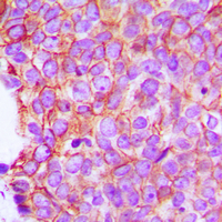 Alpha 1+2 Catenin Antibody - Immunohistochemical analysis of Catenin alpha 1/2 staining in human breast cancer formalin fixed paraffin embedded tissue section. The section was pre-treated using heat mediated antigen retrieval with sodium citrate buffer (pH 6.0). The section was then incubated with the antibody at room temperature and detected using an HRP conjugated compact polymer system. DAB was used as the chromogen. The section was then counterstained with hematoxylin and mounted with DPX.