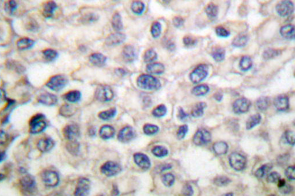 Alpha 1+2 Catenin Antibody - IHC of Catenin-1/2 (P940)pAb in paraffin-embedded human lung carcinoma tissue.