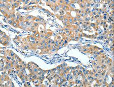 Alpha-1-Antichymotrypsin Antibody - Immunohistochemistry of paraffin-embedded Human lung cancer using SERPINA3 Polyclonal Antibody at dilution of 1:55.