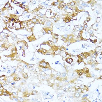 Alpha-1-Antichymotrypsin Antibody - Immunohistochemistry of paraffin-embedded Human liver cancer using SERPINA3 Polyclonal Antibody at dilution of 1:100 (40x lens).