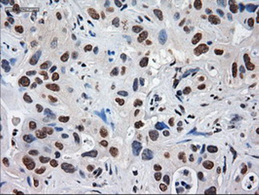 Alpha-Fetoprotein Antibody - Immunohistochemical staining of paraffin-embedded Carcinoma of Human liver tissue using anti-AFP mouse monoclonal antibody. (Heat-induced epitope retrieval by 1mM EDTA in 10mM Tris buffer. (pH8.5) at 120°C for 3 min. (1:150)