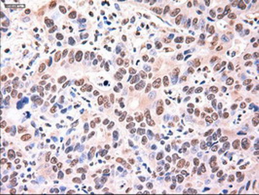 Alpha-Fetoprotein Antibody - Immunohistochemical staining of paraffin-embedded Carcinoma of Human liver tissue using anti-AFP mouse monoclonal antibody. (Heat-induced epitope retrieval by 1mM EDTA in 10mM Tris buffer. (pH8.5) at 120°C for 3 min. (1:150)
