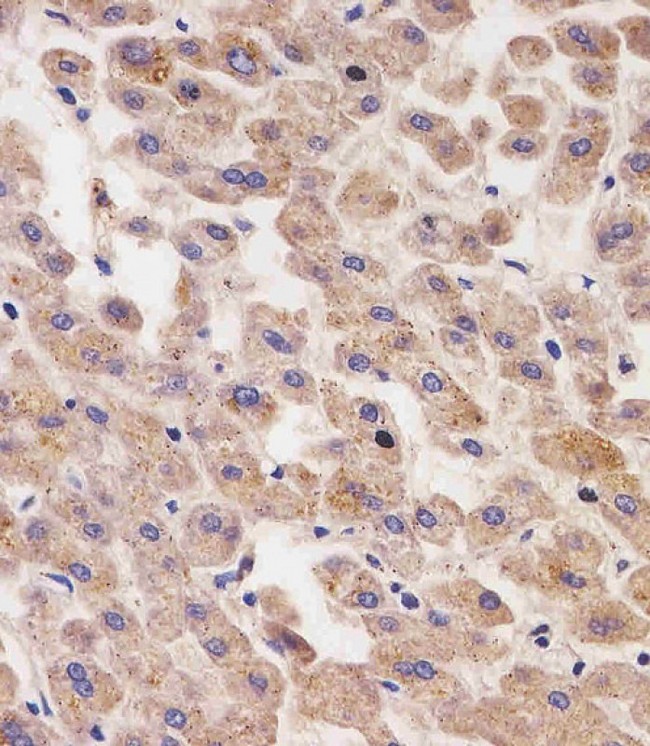 Alpha-Fetoprotein Antibody - AFP Antibody staining AFP in human liver tissue sections by Immunohistochemistry (IHC-P - paraformaldehyde-fixed, paraffin-embedded sections). Tissue was fixed with formaldehyde and blocked with 3% BSA for 0. 5 hour at room temperature; antigen retrieval was by heat mediation with a citrate buffer (pH6). Samples were incubated with primary antibody (1/25) for 1 hours at 37°C. A undiluted biotinylated goat polyvalent antibody was used as the secondary antibody.