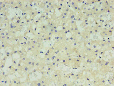 Alpha-Fetoprotein Antibody - Immunohistochemistry of paraffin-embedded human liver cancer using AFP Monoclonal Antibody in 30ug/ml dilute concentrations.