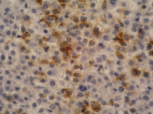 Alpha-Fetoprotein Antibody - Immunohistochemistry staining of hepatocellular carcinoma (fetal liver; paraffin-embedded sections) with anti-human alpha-Fetoprotein (AFP-11).
