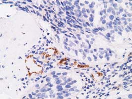 Alpha-Fetoprotein Antibody - Immunohistochemical staining of paraffin-embedded Carcinoma of Human bladder tissue using anti-AFP mouse monoclonal antibody. (Dilution 1:50).