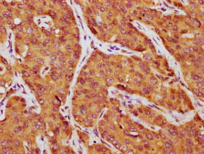Alpha-Fetoprotein Antibody - IHC image of AFP Antibody diluted at 1:750 and staining in paraffin-embedded human liver cancer performed on a Leica BondTM system. After dewaxing and hydration, antigen retrieval was mediated by high pressure in a citrate buffer (pH 6.0). Section was blocked with 10% normal goat serum 30min at RT. Then primary antibody (1% BSA) was incubated at 4°C overnight. The primary is detected by a biotinylated secondary antibody and visualized using an HRP conjugated SP system.