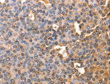 Alpha-Fetoprotein Antibody - Immunohistochemistry of paraffin-embedded Human liver cancer using AFP Polyclonal Antibody at dilution of 1:60.