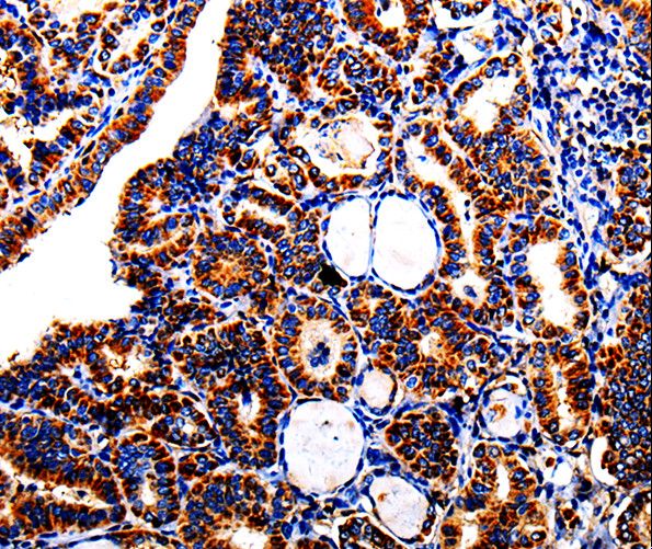 Alpha-Fetoprotein Antibody - Immunohistochemistry of paraffin-embedded Human thyroid cancer using AFP Polyclonal Antibody at dilution of 1:40.