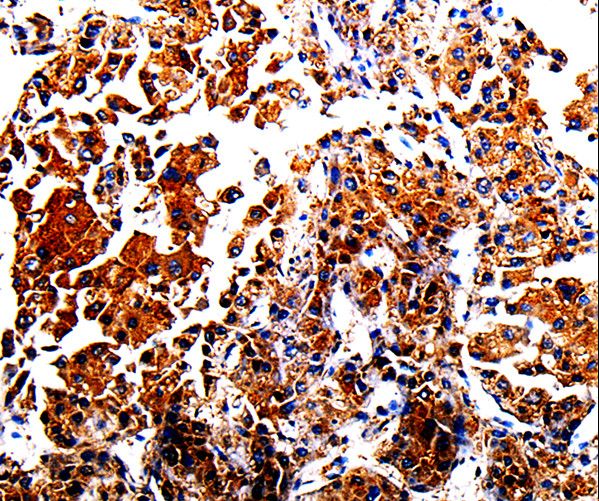 Alpha-Fetoprotein Antibody - Immunohistochemistry of paraffin-embedded Human liver cancer using AFP Polyclonal Antibody at dilution of 1:40.