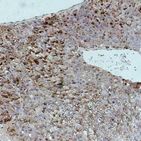 Alpha-Fetoprotein Antibody - Immunohistochemical analysis of Alpha-fetoglobulin staining in human Hepatocarcinoma formalin fixed paraffin embedded tissue section. The section was pre-treated using heat mediated antigen retrieval with sodium citrate buffer (pH 6.0). The section was then incubated with the antibody at room temperature and detected using an HRP conjugated compact polymer system. DAB was used as the chromogen. The section was then counterstained with hematoxylin and mounted with DPX.