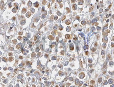 Alpha-Fetoprotein Antibody - 1/100 staining human breast  tissue by IHC-P. The sample was formaldehyde fixed and a heat mediated antigen retrieval step in citrate buffer was performed. The sample was then blocked and incubated with the antibody for 1.5 hours at 22°C. An HRP conjugated goat anti-rabbit antibody was used as the secondary antibody.
