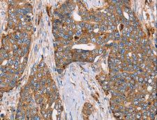 Alpha Fucosidase / FUCA1 Antibody - Immunohistochemistry of paraffin-embedded Human cervical cancer using FUCA1 Polyclonal Antibody at dilution of 1:30.