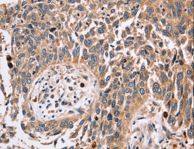 Alpha Fucosidase / FUCA1 Antibody - Immunohistochemistry of paraffin-embedded Human lung cancer using FUCA1 Polyclonal Antibody at dilution of 1:30.