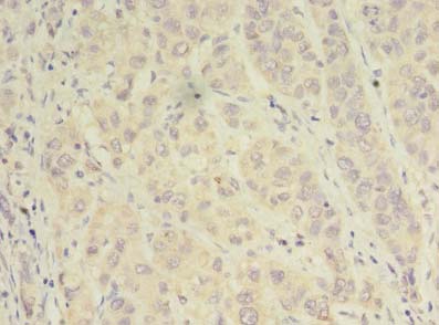 Alpha SNAP Antibody - Immunohistochemistry of paraffin-embedded human liver cancer using antibody at dilution of 1:100.
