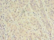 Alpha SNAP Antibody - Immunohistochemistry of paraffin-embedded human liver cancer using antibody at dilution of 1:100.