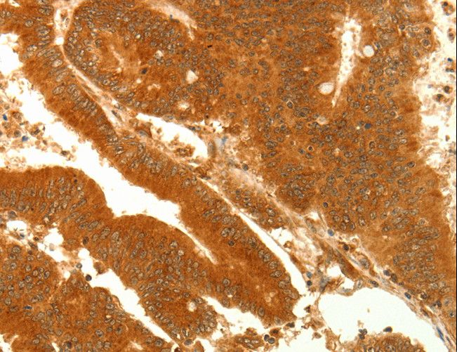 Alpha SNAP Antibody - Immunohistochemistry of paraffin-embedded Human colon cancer using NAPA Polyclonal Antibody at dilution of 1:35.