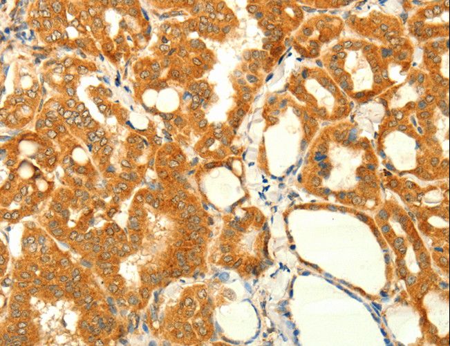 Alpha SNAP Antibody - Immunohistochemistry of paraffin-embedded Human thyroid cancer using NAPA Polyclonal Antibody at dilution of 1:35.