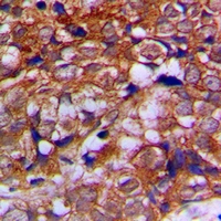 Alpha Tubulin Antibody - Immunohistochemical analysis of Alpha-tubulin staining in human prostate cancer formalin fixed paraffin embedded tissue section. The section was pre-treated using heat mediated antigen retrieval with sodium citrate buffer (pH 6.0). The section was then incubated with the antibody at room temperature and detected with HRP and DAB as chromogen. The section was then counterstained with hematoxylin and mounted with DPX.