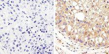 Alpha Tubulin Antibody - Immunohistochemistry analysis of Alpha-Tubulin showing staining in the cytoplasm of paraffin-embedded human breast carcinoma (right) compared to a negative control without primary antibody (left). To expose target proteins, antigen retrieval was performed using 10mM sodium citrate (pH 6.0), microwaved for 8-15 min. Following antigen retrieval, tissues were blocked in 3% H2O2-methanol for 15 min at room temperature, washed with ddH2O and PBS, and then probed with a Alpha-Tubulin diluted in 3% BSA-PBS at a dilution of 1:20 overnight at 4°C in a humidified chamber. Tissues were washed extensively in PBST and detection was performed using an HRP-conjugated secondary antibody followed by colorimetric detection using a DAB kit. Tissues were counterstained with hematoxylin and dehydrated with ethanol and xylene to prep for mounting.