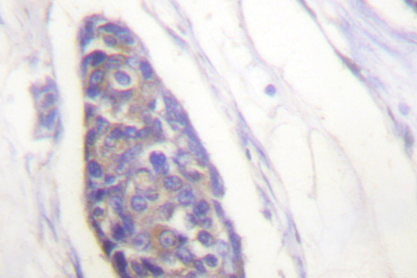 Alpha Tubulin Antibody - IHC of Tubulin (G436) pAb in paraffin-embedded human breast carcinoma tissue.