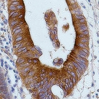 Alpha Tubulin Antibody - Immunohistochemical analysis of Alpha-tubulin staining in human colon cancer formalin fixed paraffin embedded tissue section. The section was pre-treated using heat mediated antigen retrieval with sodium citrate buffer (pH 6.0). The section was then incubated with the antibody at room temperature and detected using an HRP conjugated compact polymer system. DAB was used as the chromogen. The section was then counterstained with hematoxylin and mounted with DPX.