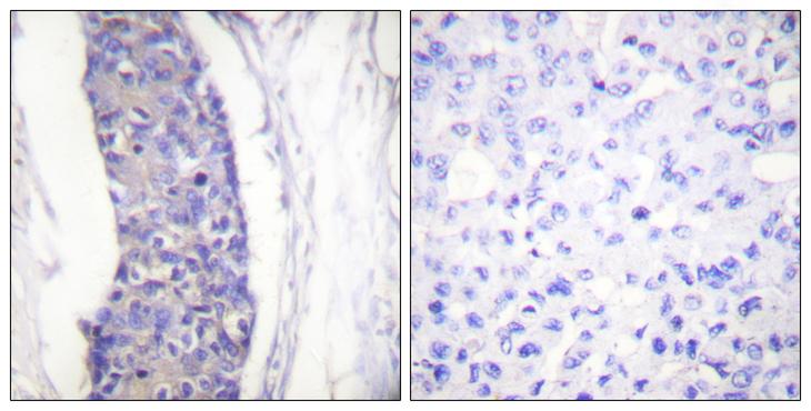 Alpha Tubulin Antibody - Peptide - + Immunohistochemistry analysis of paraffin-embedded human breast carcinoma tissue using Tubulin a antibody.