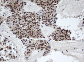 Alpha4GnT / A4GNT Antibody - IHC of paraffin-embedded Carcinoma of Human pancreas tissue using anti-A4GNT mouse monoclonal antibody.