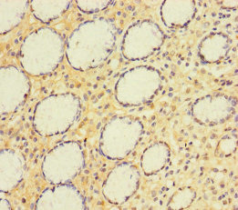 Alpha4GnT / A4GNT Antibody - Immunohistochemistry of paraffin-embedded human gastric cancer using A4GNT Antibody at dilution of 1:100