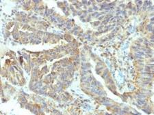 ALPL / Alkaline Phosphatase Antibody - IHC testing of FFPE human ovarian carcinoma with ALPL antibody (clone V17.1). Required HIER: boil tissue sections in 10mM Tris with 1mM EDTA, pH 9, for 10-20 min followed by cooling at RT for 20 min.