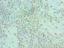 ALS2 / Alsin Antibody - Immunohistochemistry of paraffin-embedded human breast cancer using antibody at 1:100 dilution.