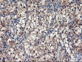 ALS2CR1 / NIF3L1 Antibody - IHC of paraffin-embedded Carcinoma of Human kidney tissue using anti-NIF3L1 mouse monoclonal antibody.